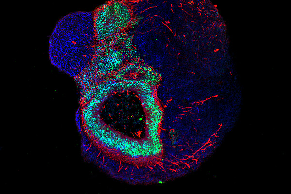 Cell-based treatment marks a major milestone in patient-centricity.